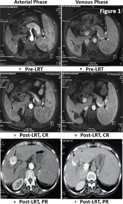 Prognostic and Therapeutic Potentials of OncomiRs Modulating mTOR Pathways in Virus-Associated Hepatocellular Carcinoma